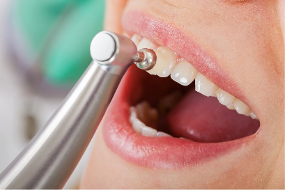 Dental polisher on teeth