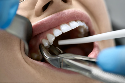 tooth being extracted by a dentist